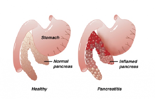 Pancreatitis in cats. Healthy pancreas compared with inflamed pancreas