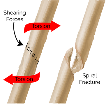 Spiral fracture illustration of soft puppy bone due to torsion