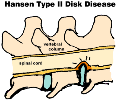 Hansen Type II IVDD in dogs. Intervertebral disc disease in dogs. IVDD in dogs. Bulging disc in dogs. ivdd dachshund. 