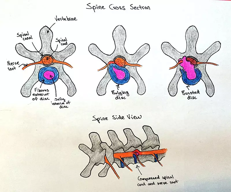 Intervertebral disc disorder in dogs - causes, symptoms, treatment & cost