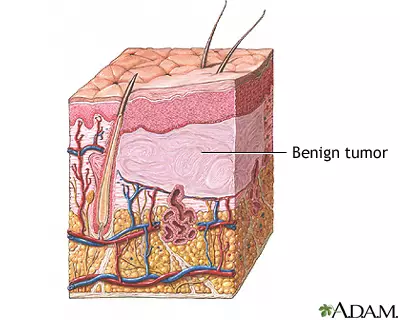 Benign tumour of the skin. Benign tumor on dog; benign growth on dog; non cancerous tumours in dogs