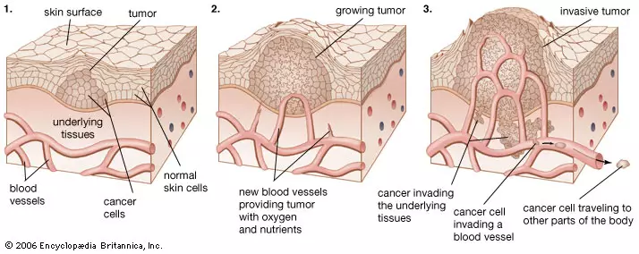 Malignant mass lesion. Malignant cancer in dog, malignant cancer in cat. Skin cancer dog, skin cancer cat. Benign tumour on dog; benign growth on dog; non cancerous tumors in dogs