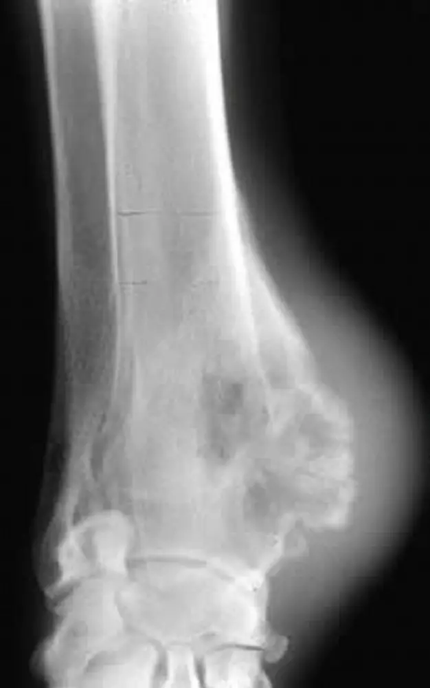 Osteosarcoma in dog. Bone tumour, bone cancer.