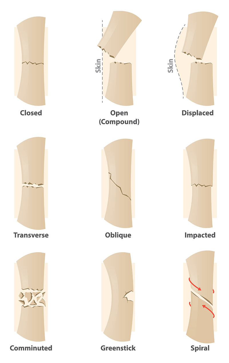 Types of bone fractures in dogs and cats. Dog pelvic limb fracture; dog hind limb fracture; fracture of pelvic limb; dog pelvic limb; dog hind limb