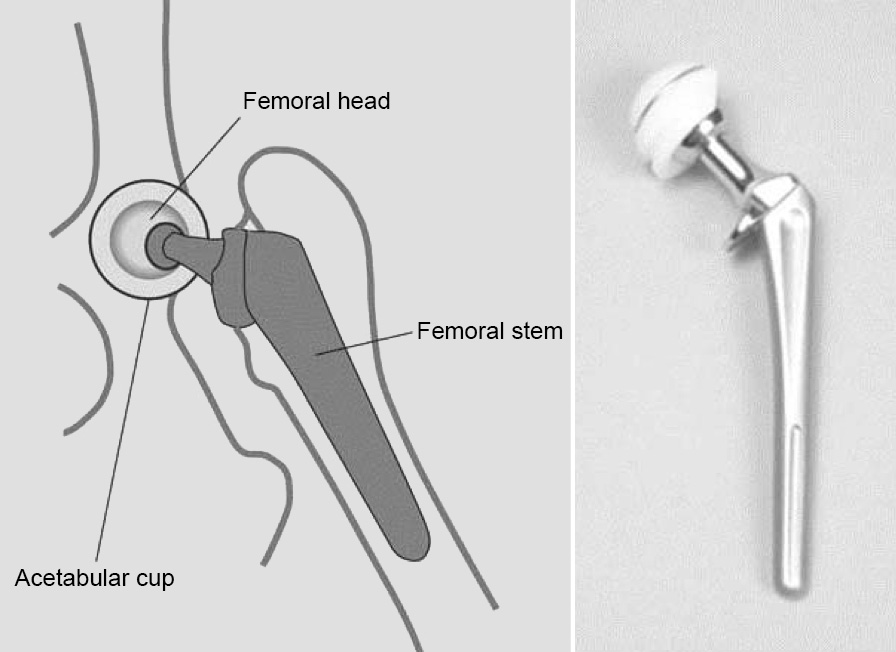 THR 2 - Schematic (left) and photo (right) of the prosthetic components used in canine total Total Hip Replacement (THR)