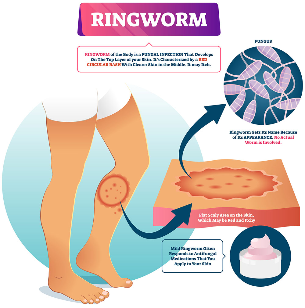ringworm on humans illustration